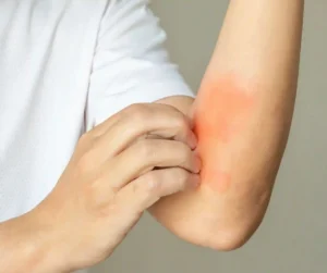 Allergic Reactions