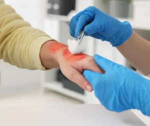 Emergency Room for a Burn