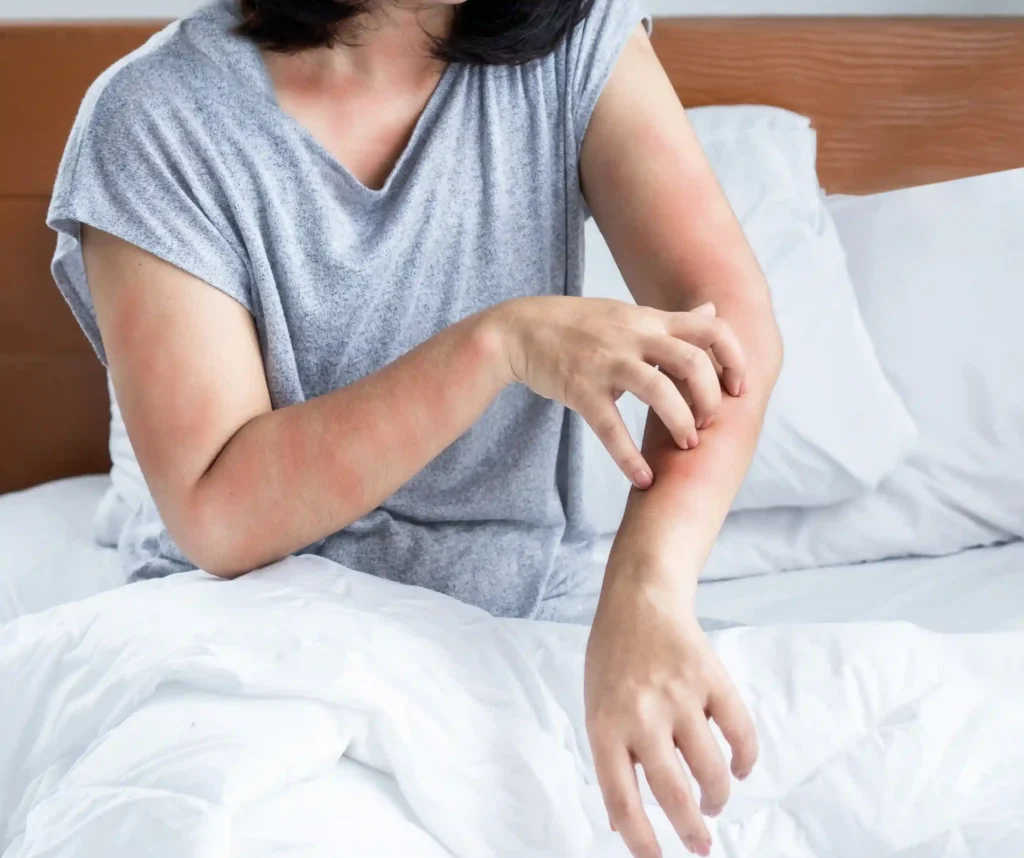 Allergic Skin Rash Remedies