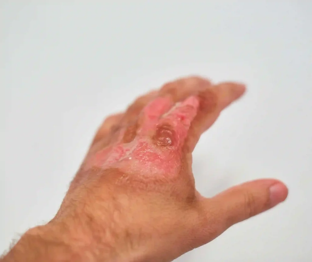 Electrical Burns