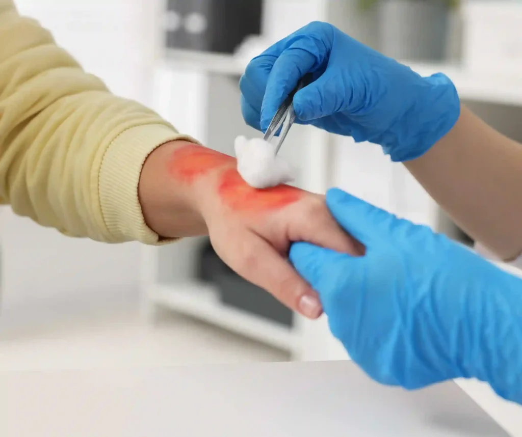 Emergency Room for a Burn