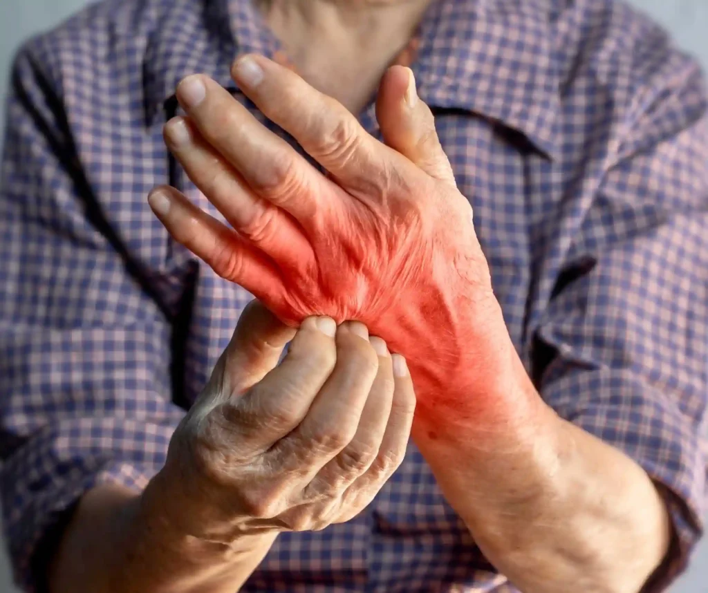 Hands Rashes