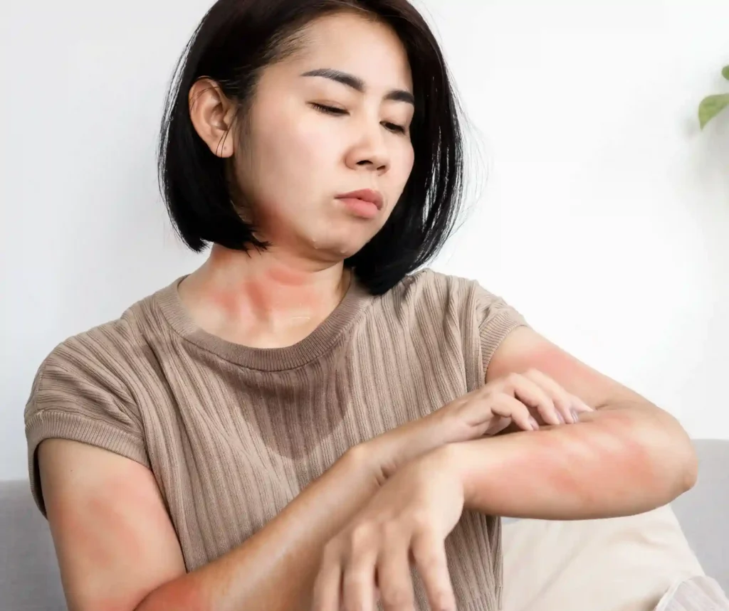 Rashes Treatment