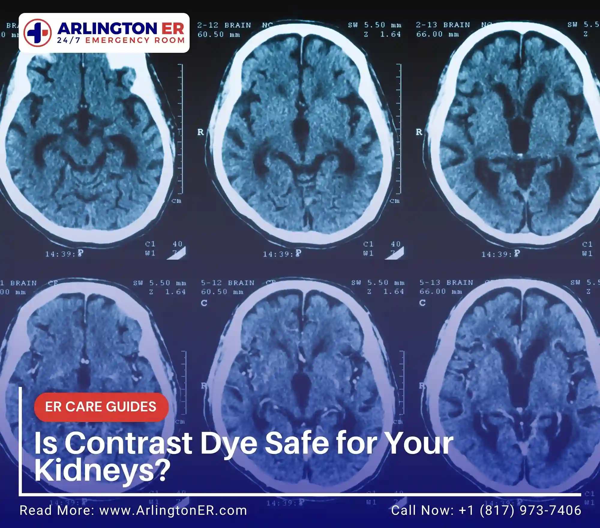 Is Contrast Dye Safe for Your Kidneys